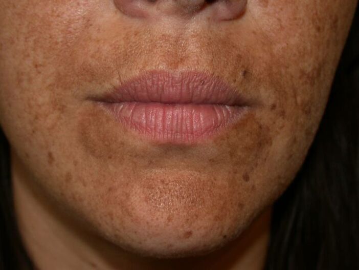 Les taches pigmentées sur le visage sont une indication pour une procédure au laser. 