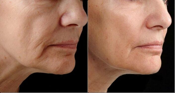 Peau du visage avant et après la procédure de resurfaçage au laser. 