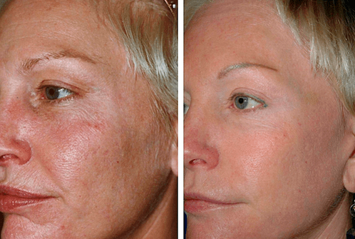avant et après rajeunissement fractionné de la peau photo 1