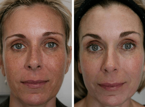 avant et après rajeunissement fractionné de la peau photo 4