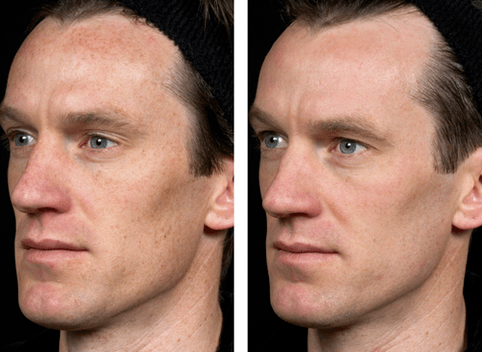 avant et après rajeunissement fractionné de la peau photo 5