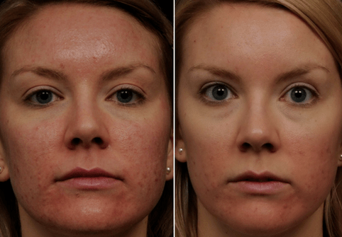 avant et après rajeunissement fractionné de la peau photo 6
