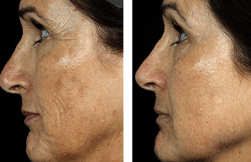 avant et après rajeunissement fractionné de la peau photo 7