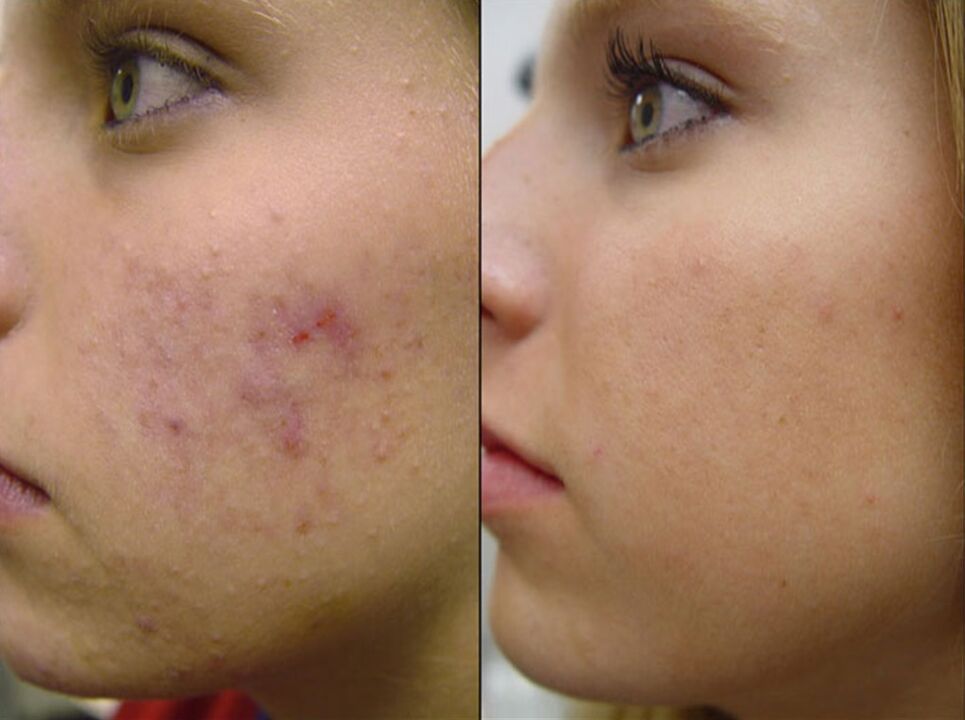 avant et après le matériel de rajeunissement de la peau photo 2