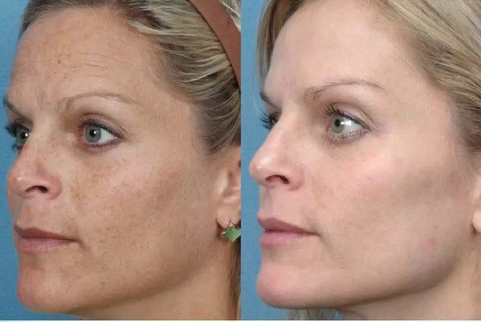avant et après rajeunissement matériel de la peau photo 1