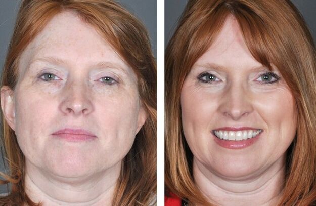 Procédure de rajeunissement facial avant et après une série de procédures
