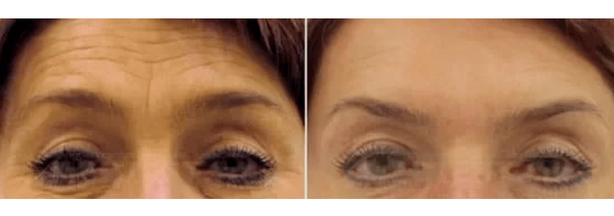 appareils pour le rajeunissement fractionné