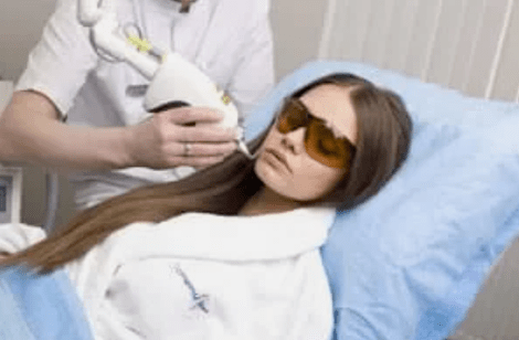 resurfaçage fractionné au laser